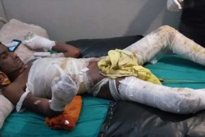 पेट्रोलले जलेर गम्भीर घाइते पाठकलाई रकम अभावले उपचारमा समस्या